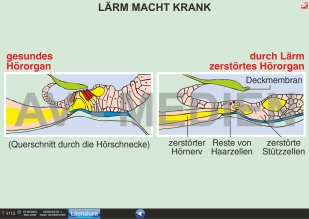 Lärm macht krank