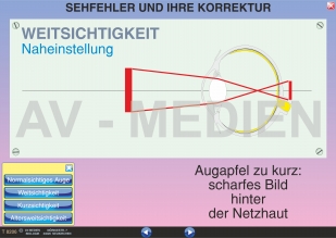 Sehfehler und ihre Korrektur