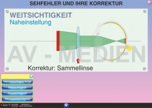 Sehfehler und ihre Korrektur