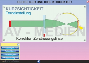 Sehfehler und ihre Korrektur