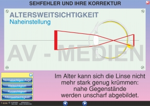 Sehfehler und ihre Korrektur